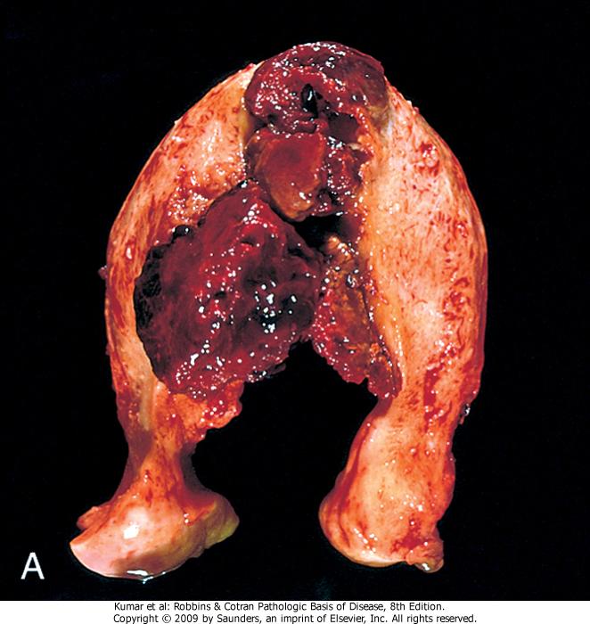 choriocarcinoma gross image