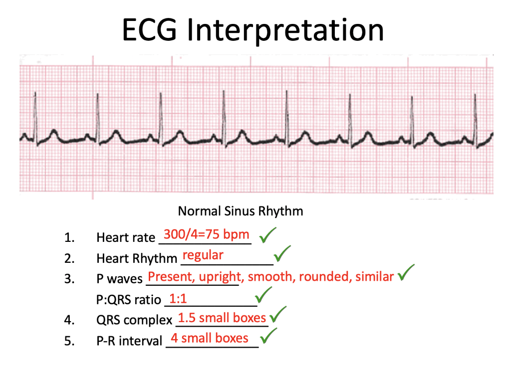 Normal Ecg Means No Heart Problem