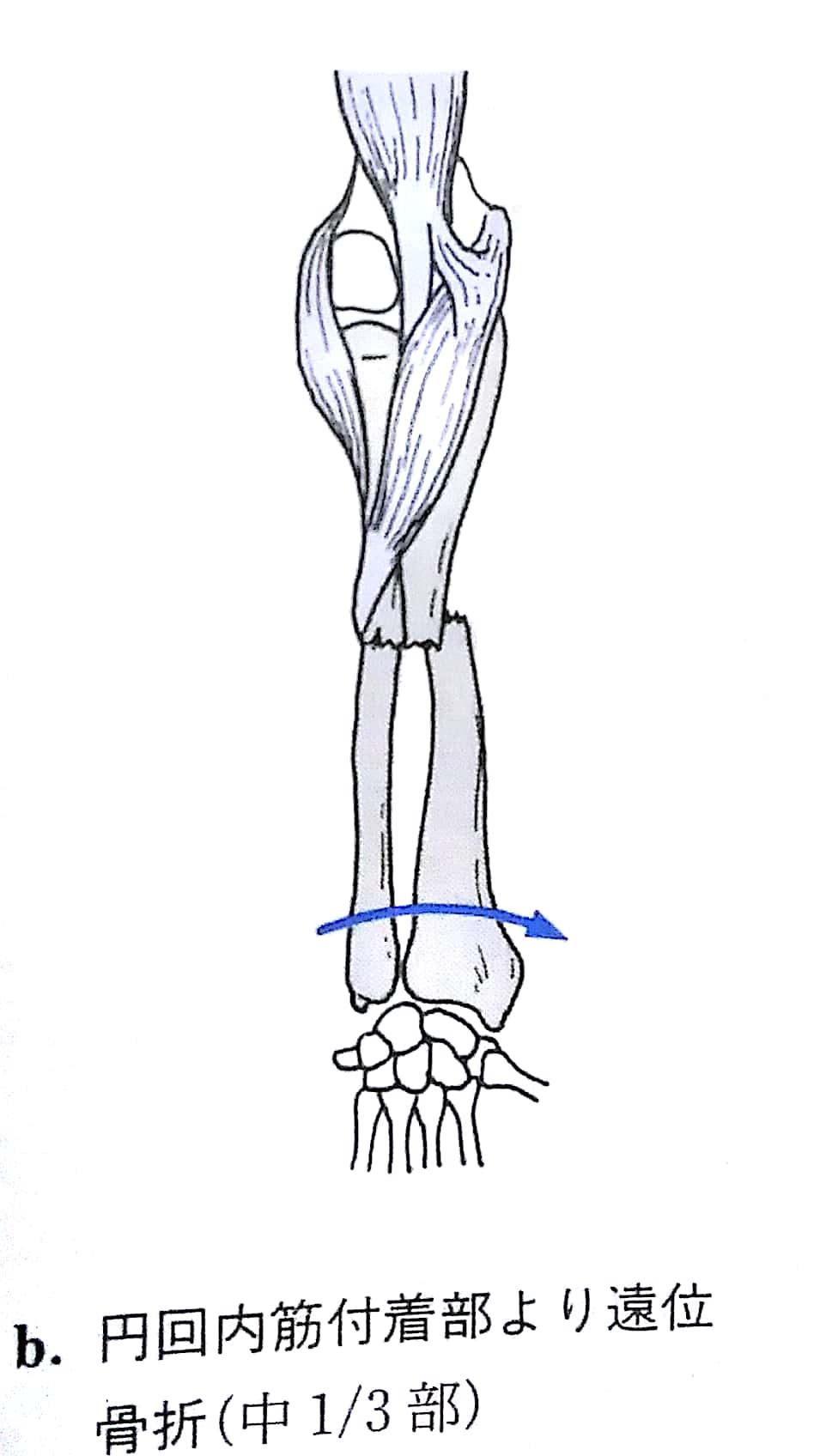 肘 手の骨折脱臼 Flashcards Chegg Com