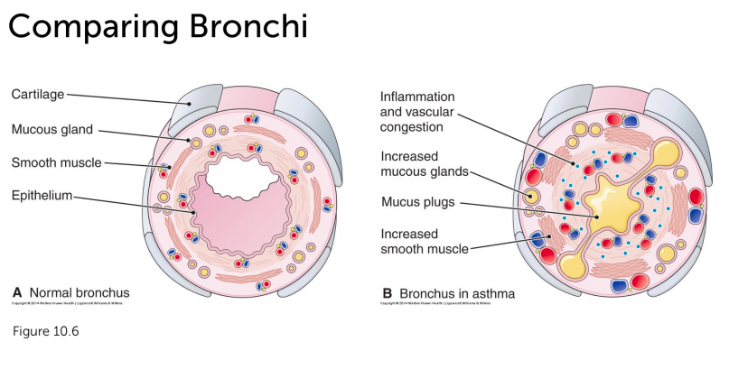 solved-describe-a-normal-bronchus-and-discuss-how-the-chegg