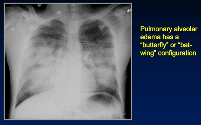 pulmonary edema x ray butterfly pattern