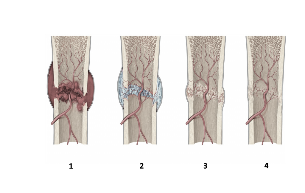 Solved label the four stages of fracture repair shown in the | Chegg.com