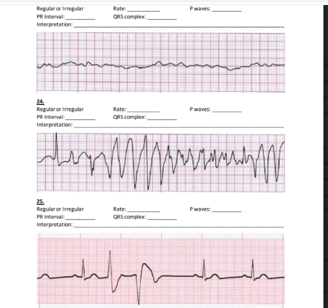 Solved P waves: Regular or Irregular PR Interval: | Chegg.com