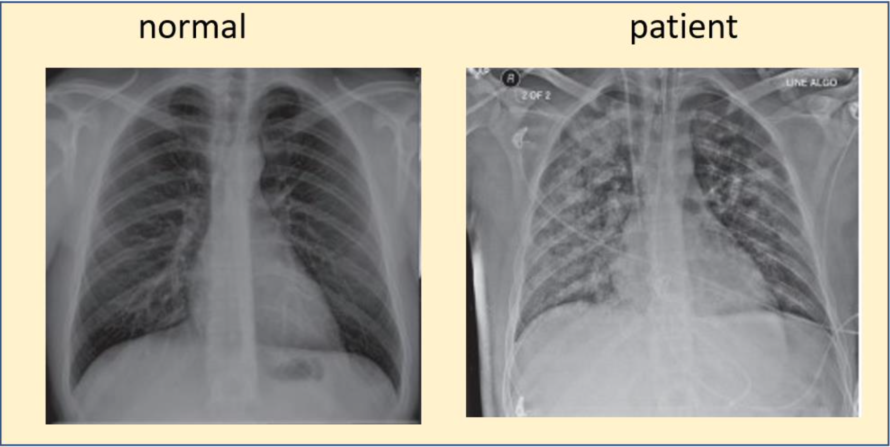 Solved A 56 year-old woman presented with chest pain and | Chegg.com