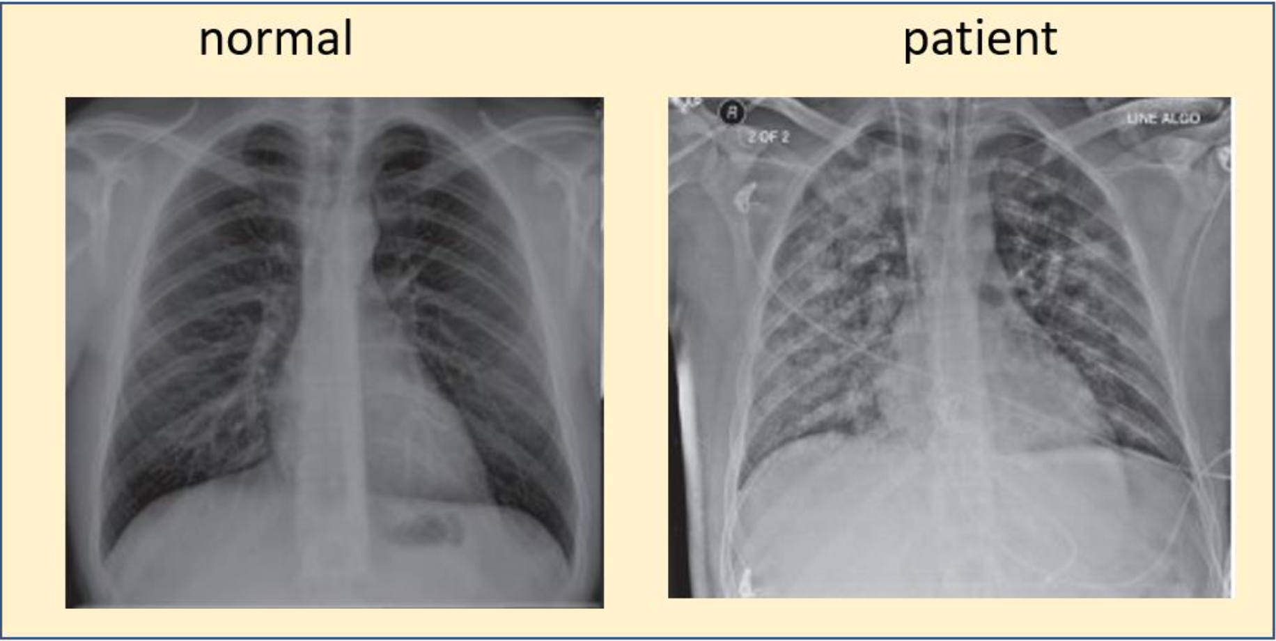 Solved A 56 Year-old Woman Presented With Chest Pain And | Chegg.com