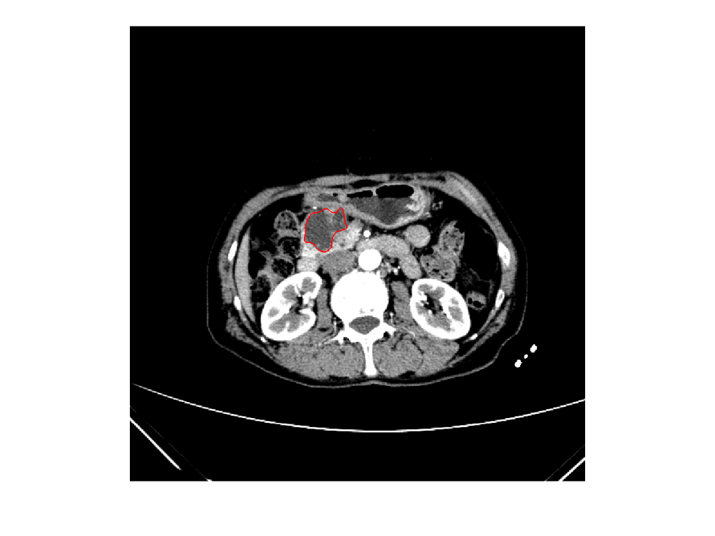 Matlab programming Tumor classification system of CT | Chegg.com