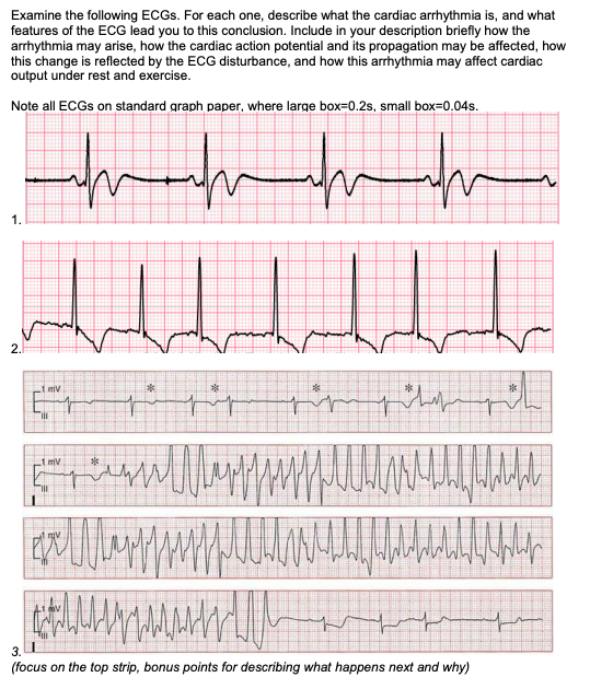 Solved Examine the following ECGs. For each one, describe | Chegg.com