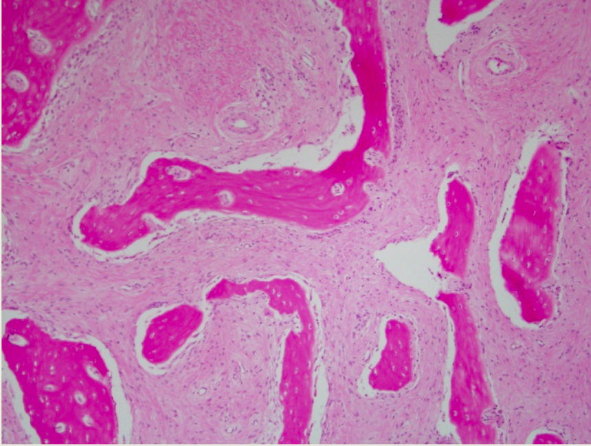 Torus Mandibularis Histology