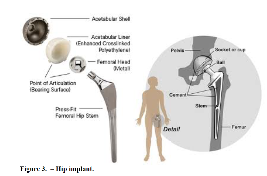 a) Components of a total hip replacement; (b) The components
