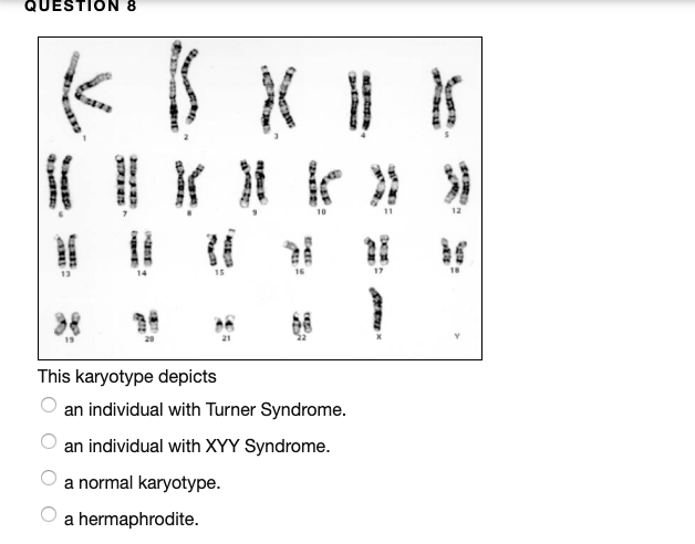 Xyy Syndrome Reproductive Medbullets Step 1 5862