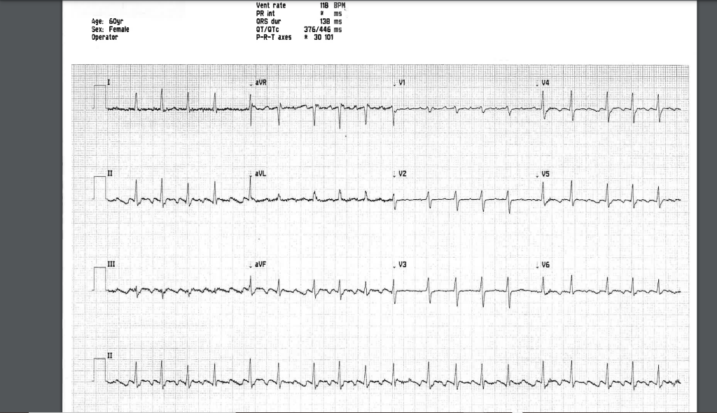 Solved what is the rhythm of this ECG and if there is
