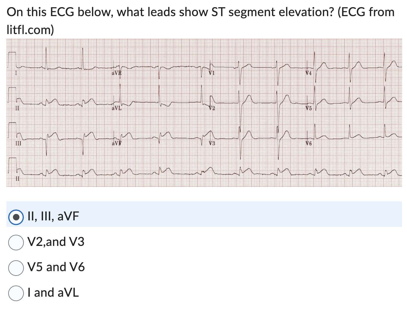 Solved On this ECG below, what leads show ST segment | Chegg.com