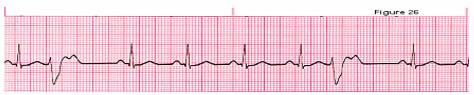 Solved a. Normal sinus rhythm f. 2nd degree AV Block Type 1 | Chegg.com