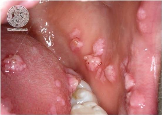 acute lymphonodular pharyngitis