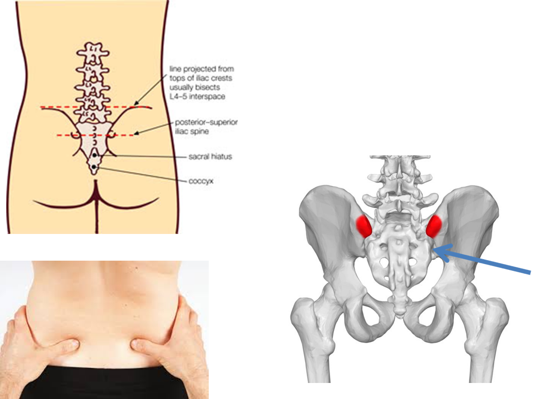 posterior-superior-iliac-spine-palpation
