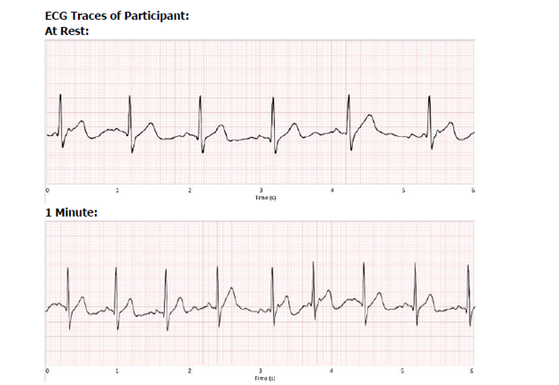 Solved How to determine heart rate (using the six second | Chegg.com