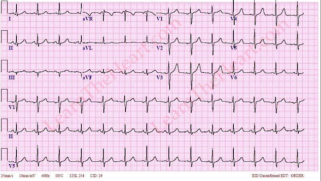 Solved 9. (5 pts) Each lead on the supplied ECG shows two | Chegg.com