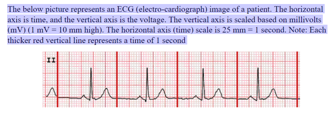 The below picture represents an ECG | Chegg.com