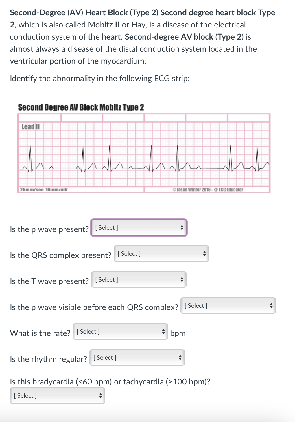 icd 10 code for heart block av second degree