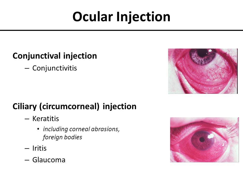 conjunctival injection