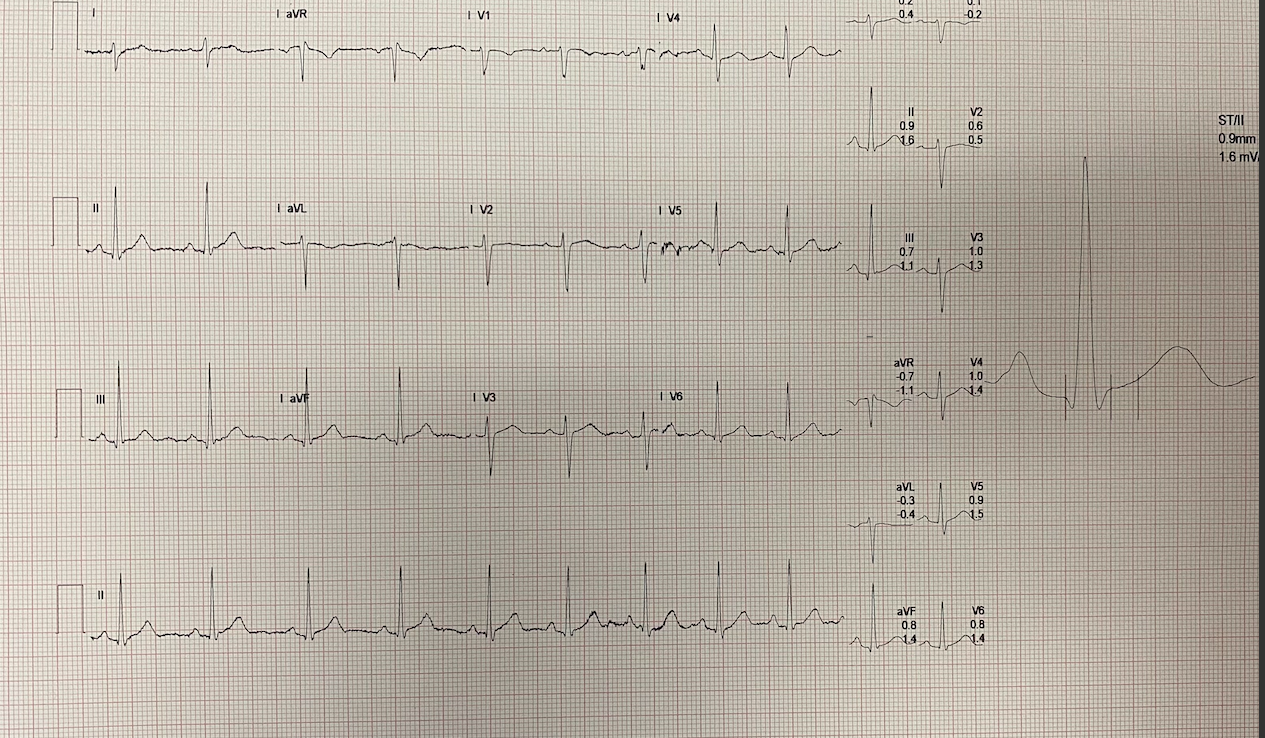 Solved Heart Rate and Rhythm (average is accepted) | Chegg.com