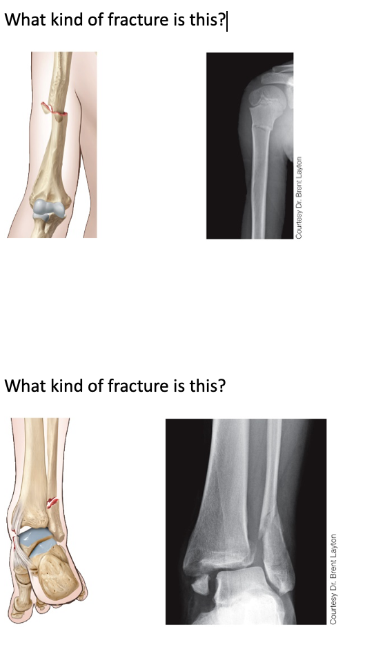 Solved In terms of a closed fracture open fracture Chegg