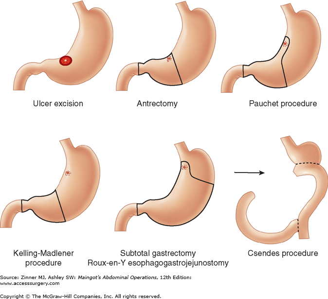 vagotomy and antrectomy