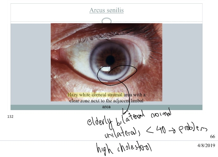 Limbus Sign And Arcus Senilis