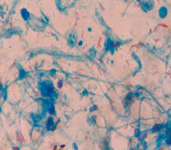 Solved A middle aged male patient arrived with violent cough