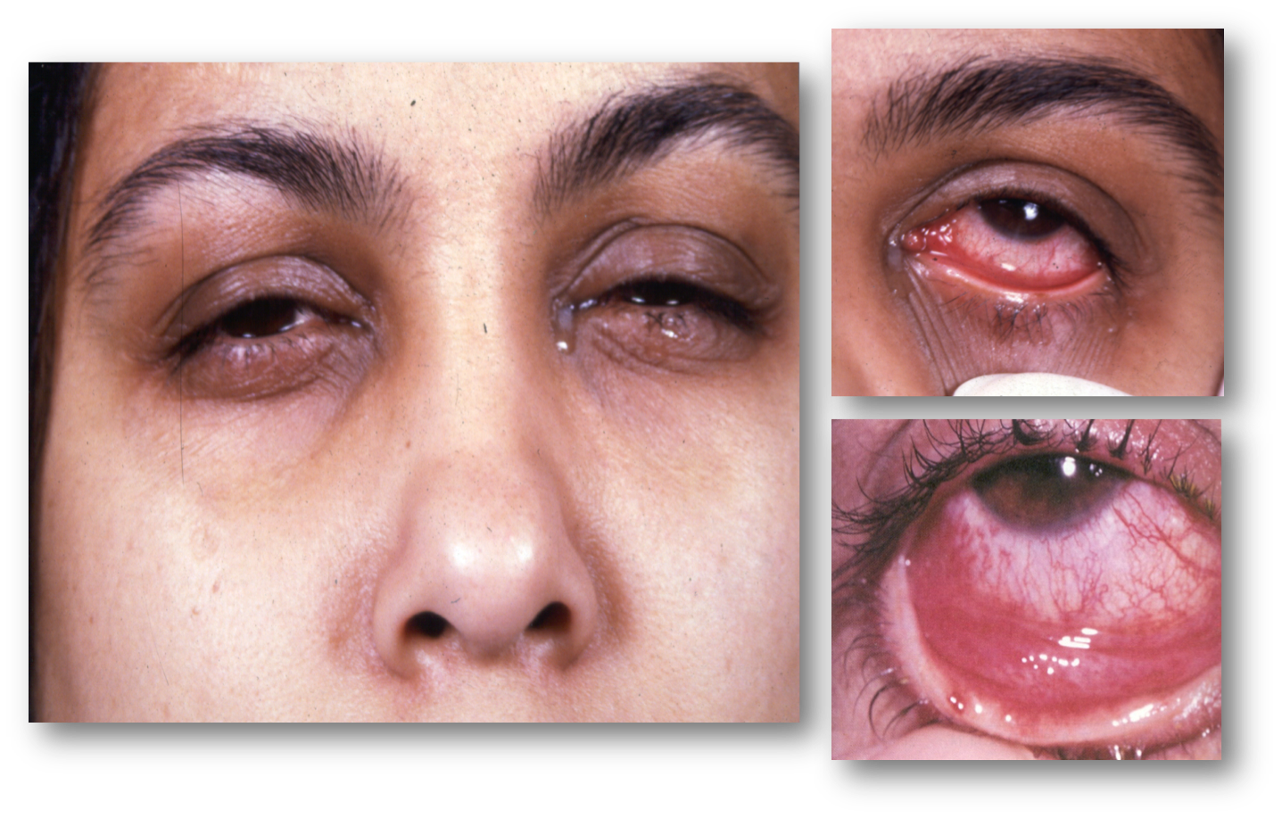 pharyngoconjunctival fever