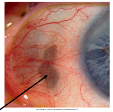 senile scleral plaque