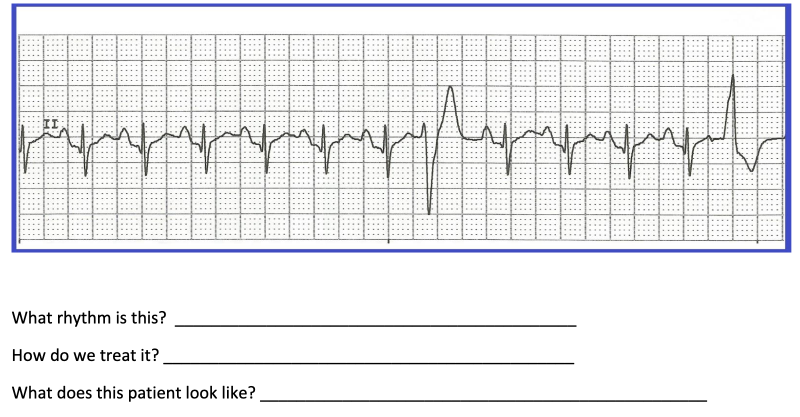 Solved Русе What rhythm is this? How do we treat it? What | Chegg.com