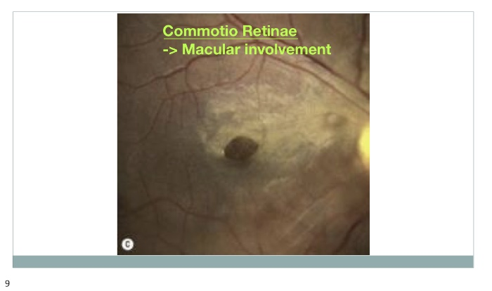 commotio retinae treatment