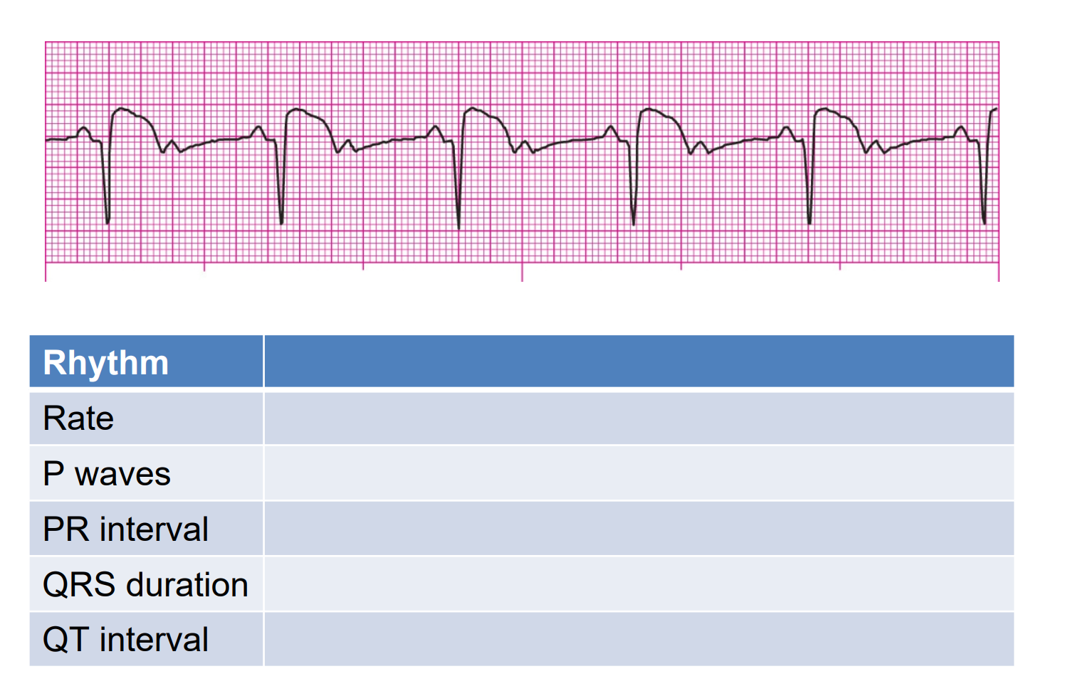 Solved Rhythm Rate P waves PR interval QRS duration QT | Chegg.com