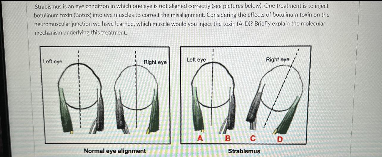 Strabismus is an eye condition in which one eye is not aligned correctly (see pictures below). One treatment is to inject bot