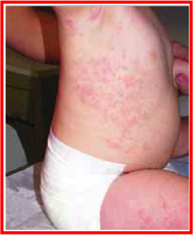 Unilateral Rash Unilateral Laterothoracic Exanthem