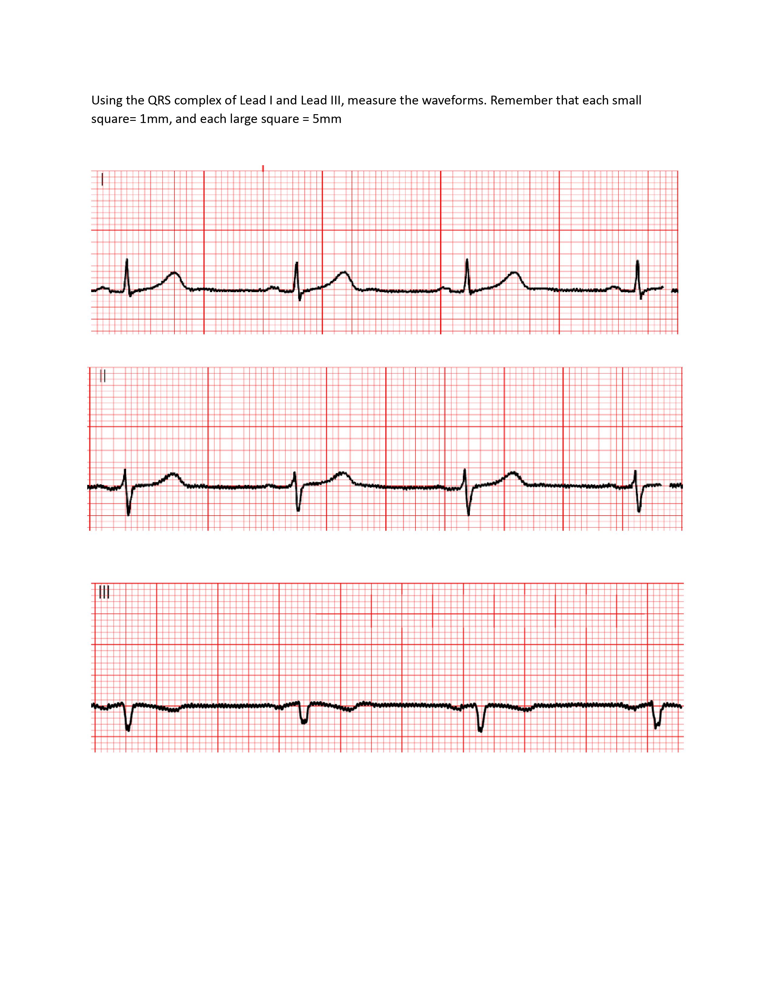 Using the QRS complex of Lead I and Lead III, measure | Chegg.com