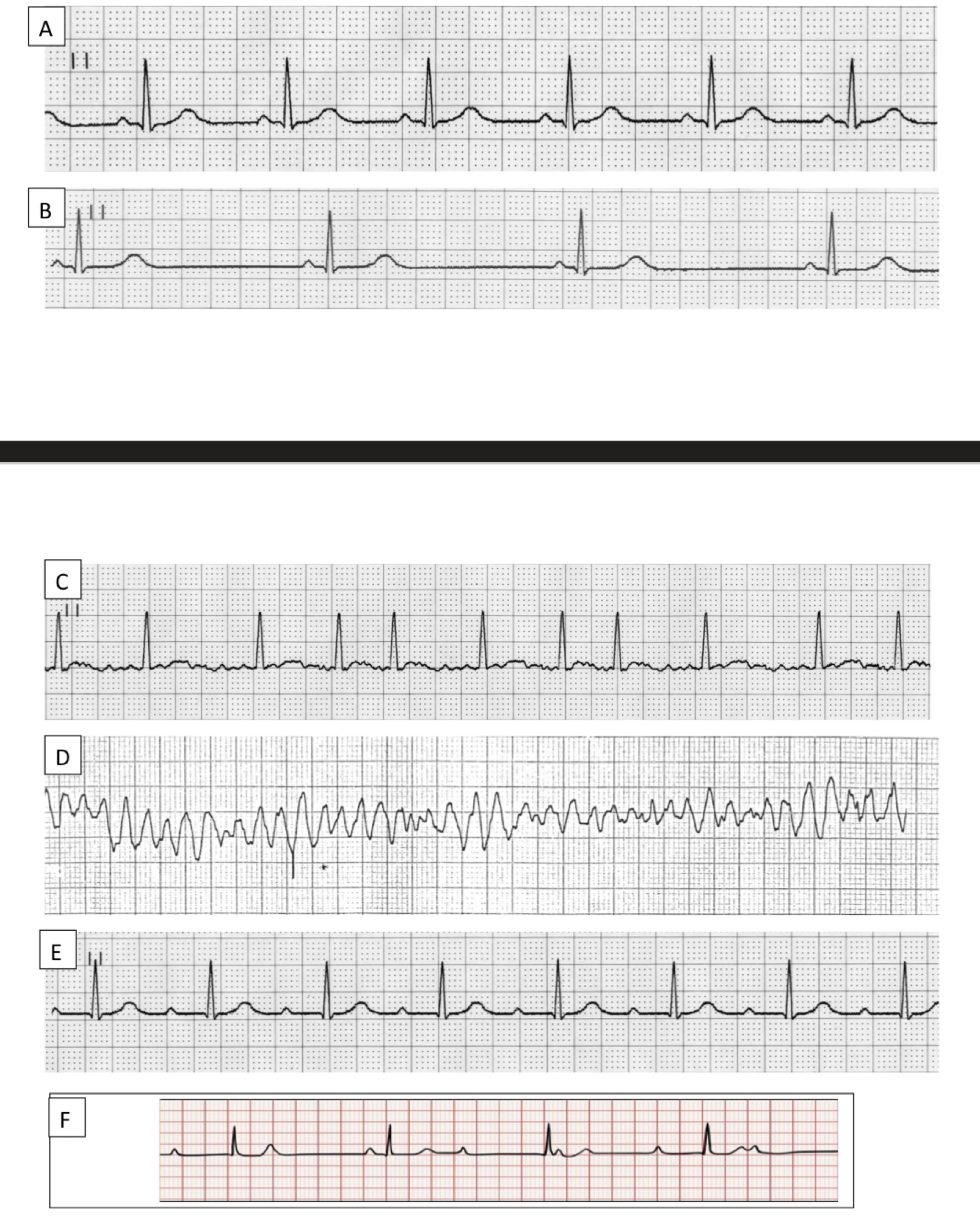 Solved 1) Rhythm (regular/irregular/other) 2) If a QRS | Chegg.com