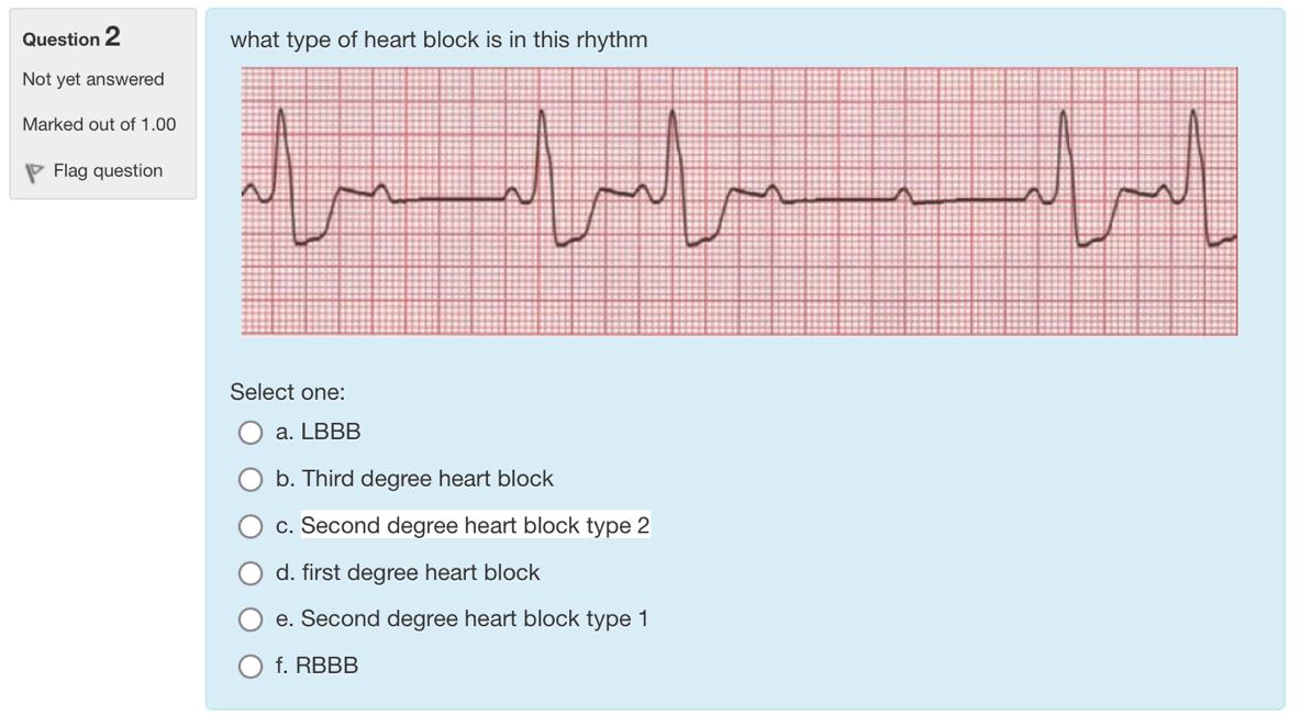 Solved Question 2 what type of heart block is in this rhythm | Chegg.com