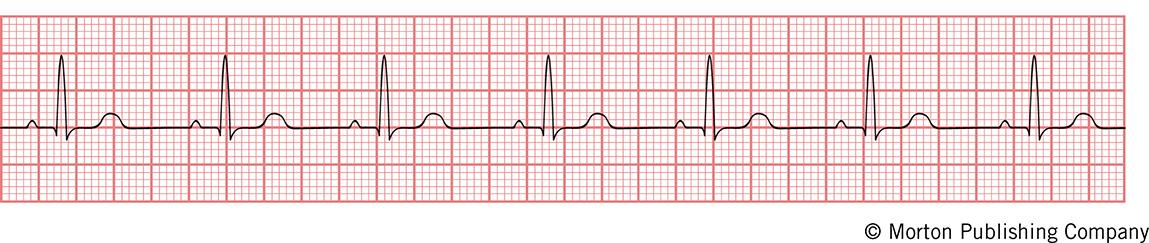 Solved 1.The characterization for the heart sounds that is | Chegg.com