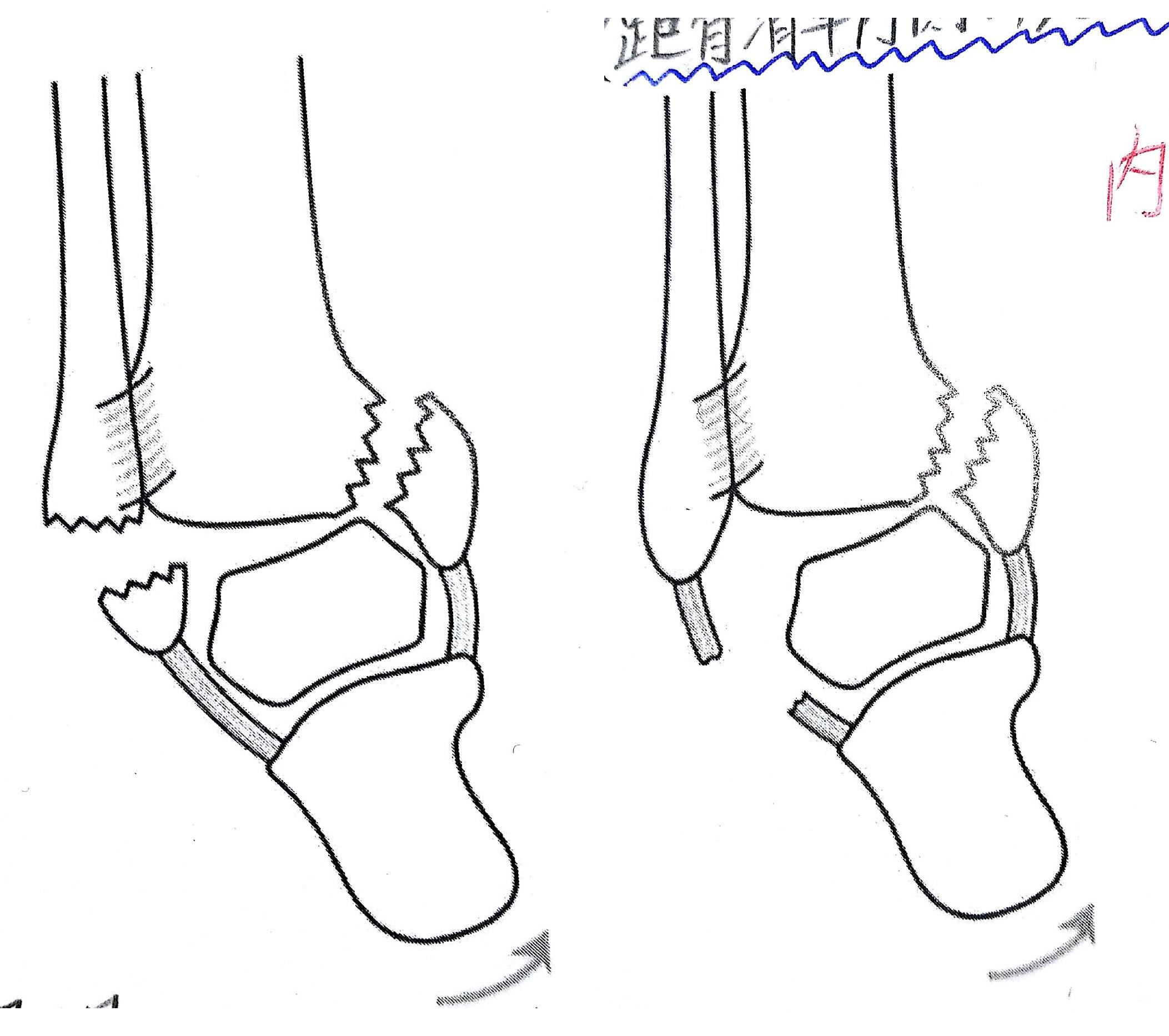 柔整各論 下肢の骨折 下腿骨 足指骨 Flashcards Chegg Com