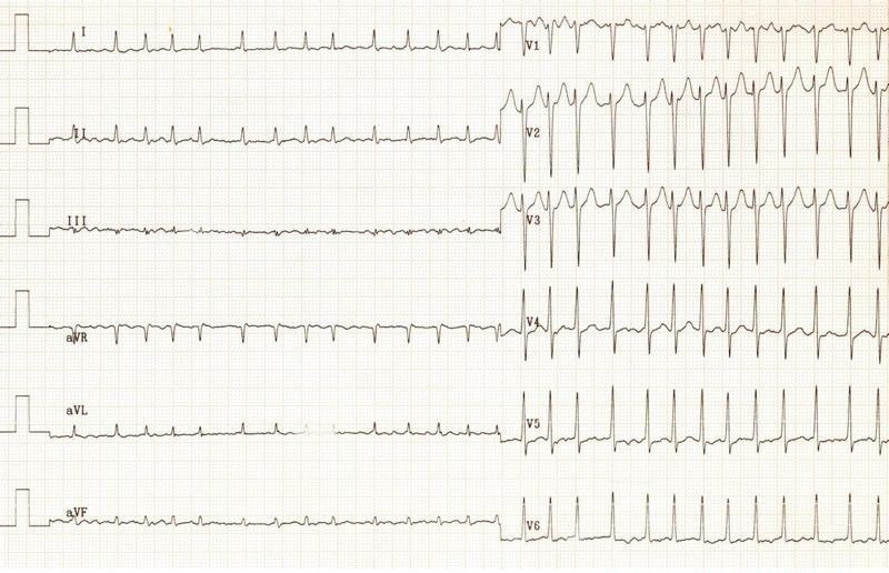 Solved A 35 ﻿year old man presents with palpitations. He has | Chegg.com