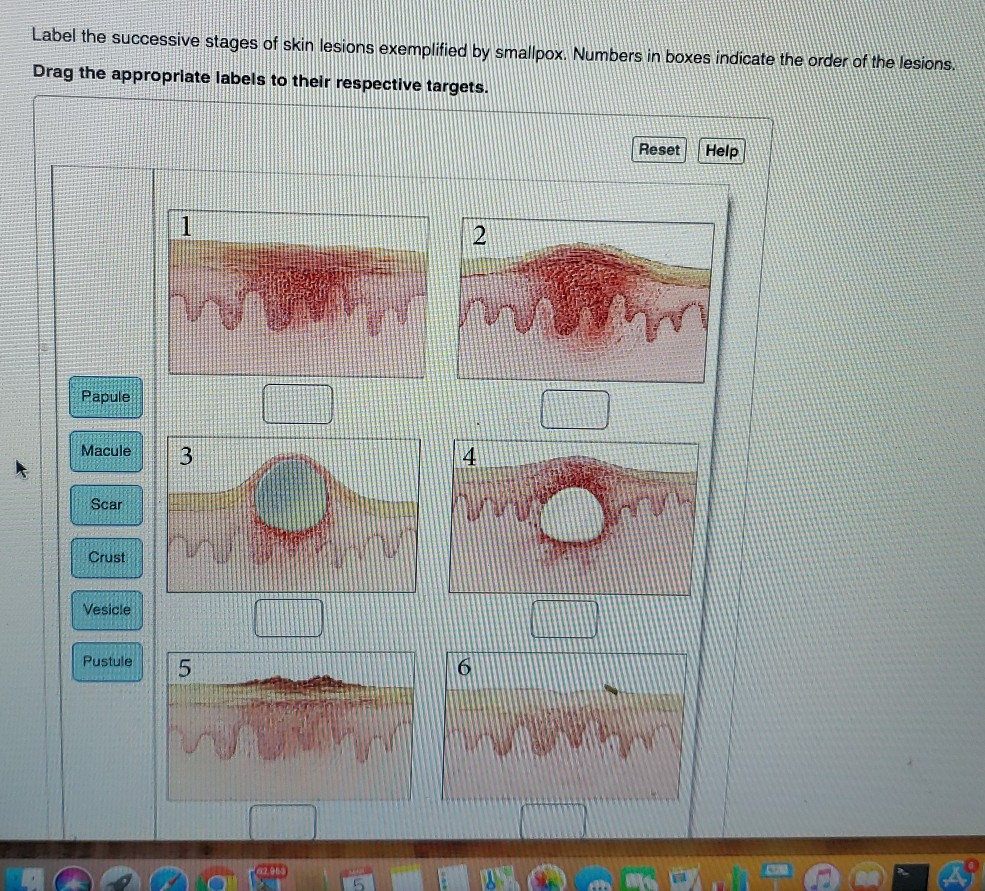the kin lesions associated with mallpox quizlet