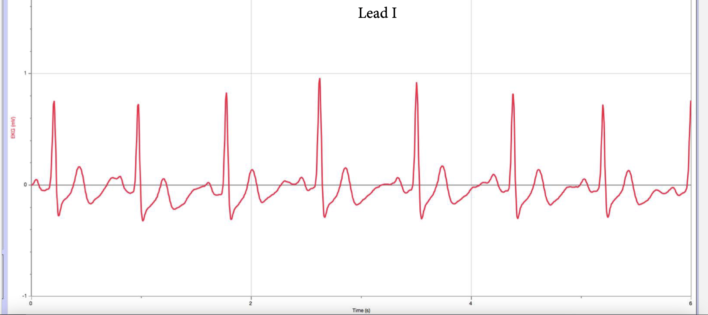 Calculate the axis of a heart, or two, using EKG | Chegg.com