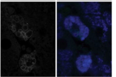 Rare Diseases India on X: Niemann-Pick is a rare, inherited