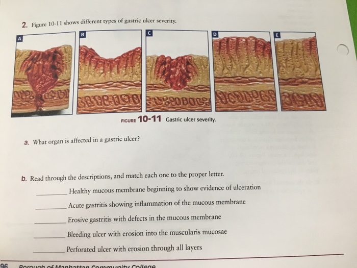 solved-2-figure-10-11-shows-different-types-of-gastric-chegg