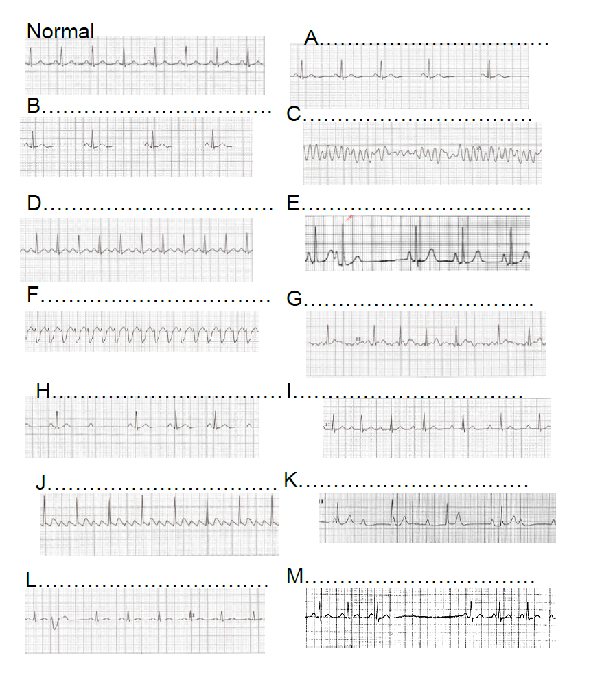 Identification Of Abnormal Ecgs All Traces Are From Chegg Com