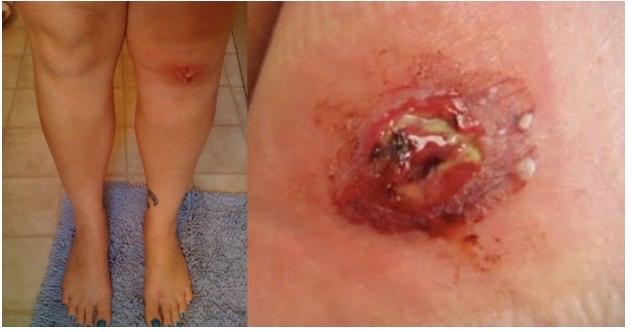 Been meaning to post this for a year. My gnarly staph infection that left a  gaping hole in my knee. Had 4 very painful infections total (2 on the face)  before they