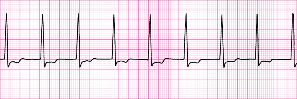 Solved Normal Sinus Rhythm (NSR)Accelerated Junctional | Chegg.com