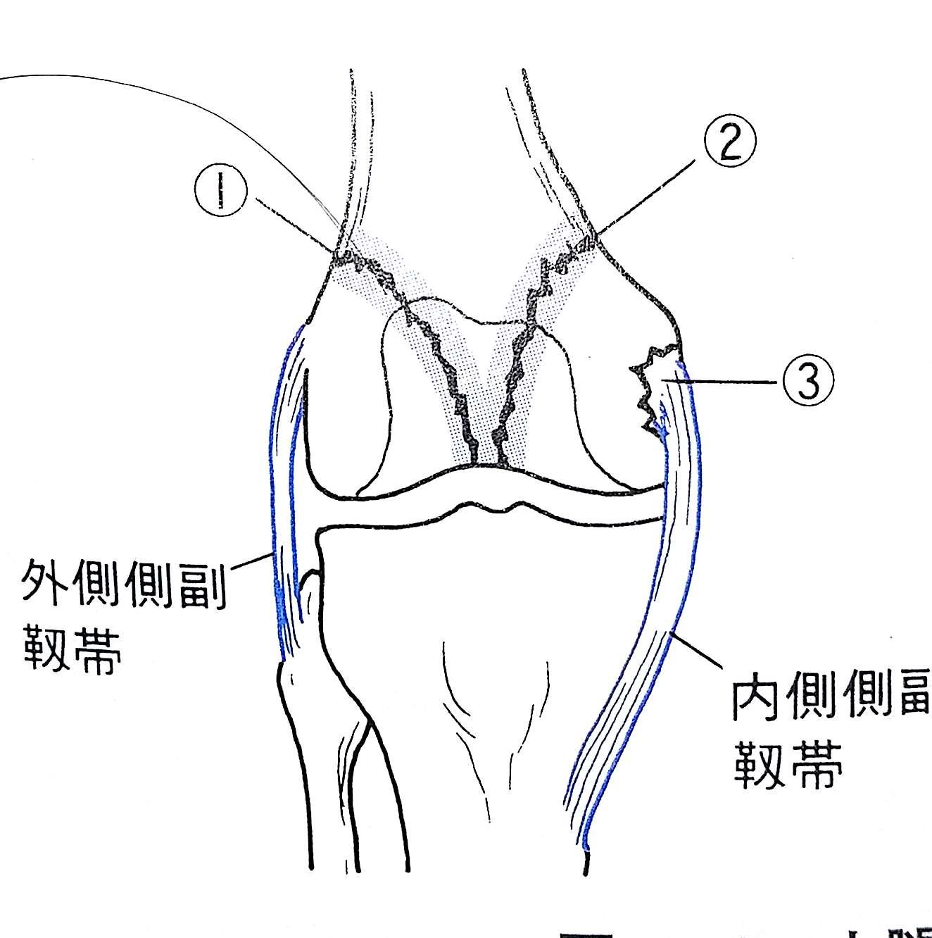 柔整各論 下肢の骨折 骨盤骨 膝蓋骨 Flashcards Chegg Com